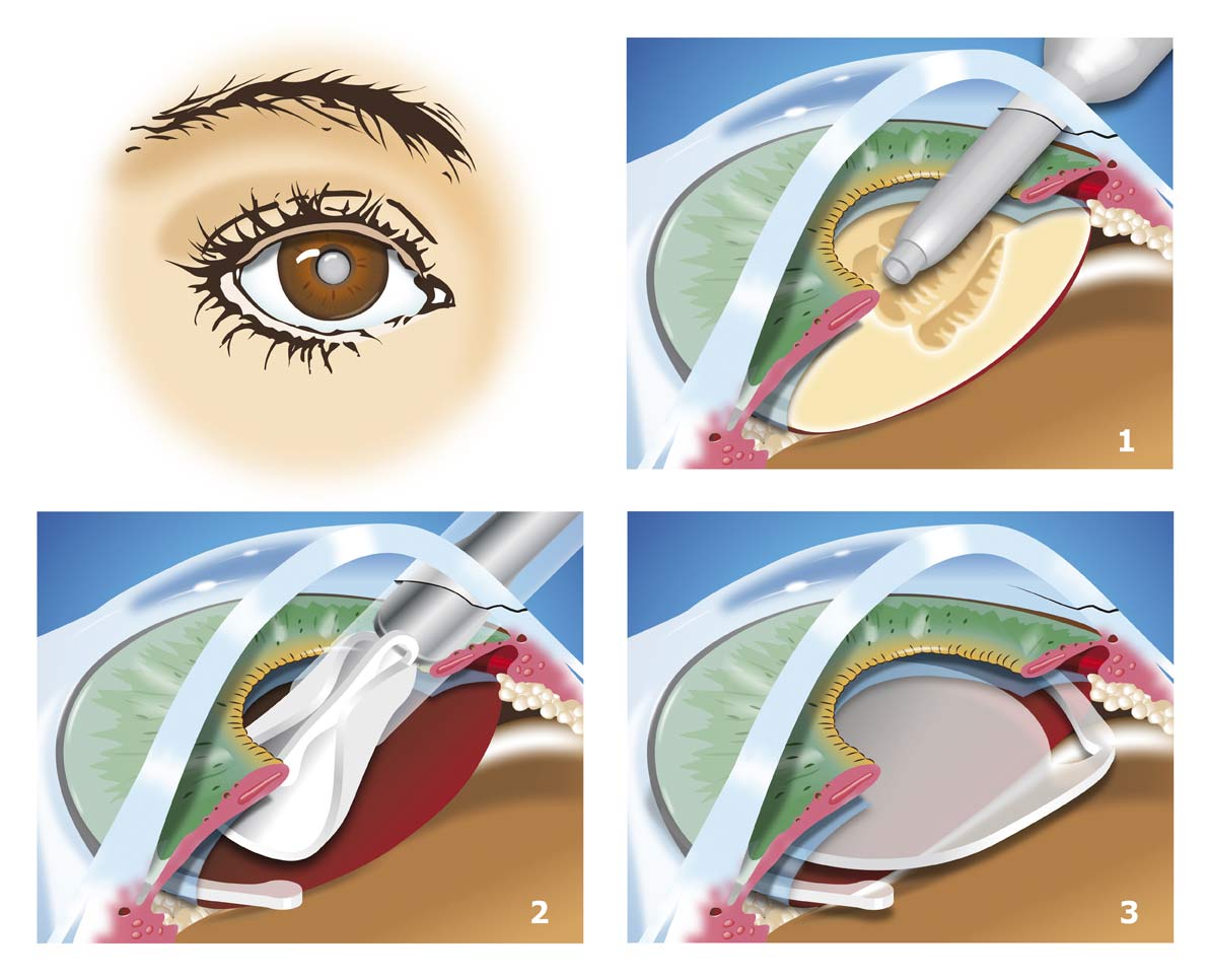 Diagram of the different steps of cataract surgery